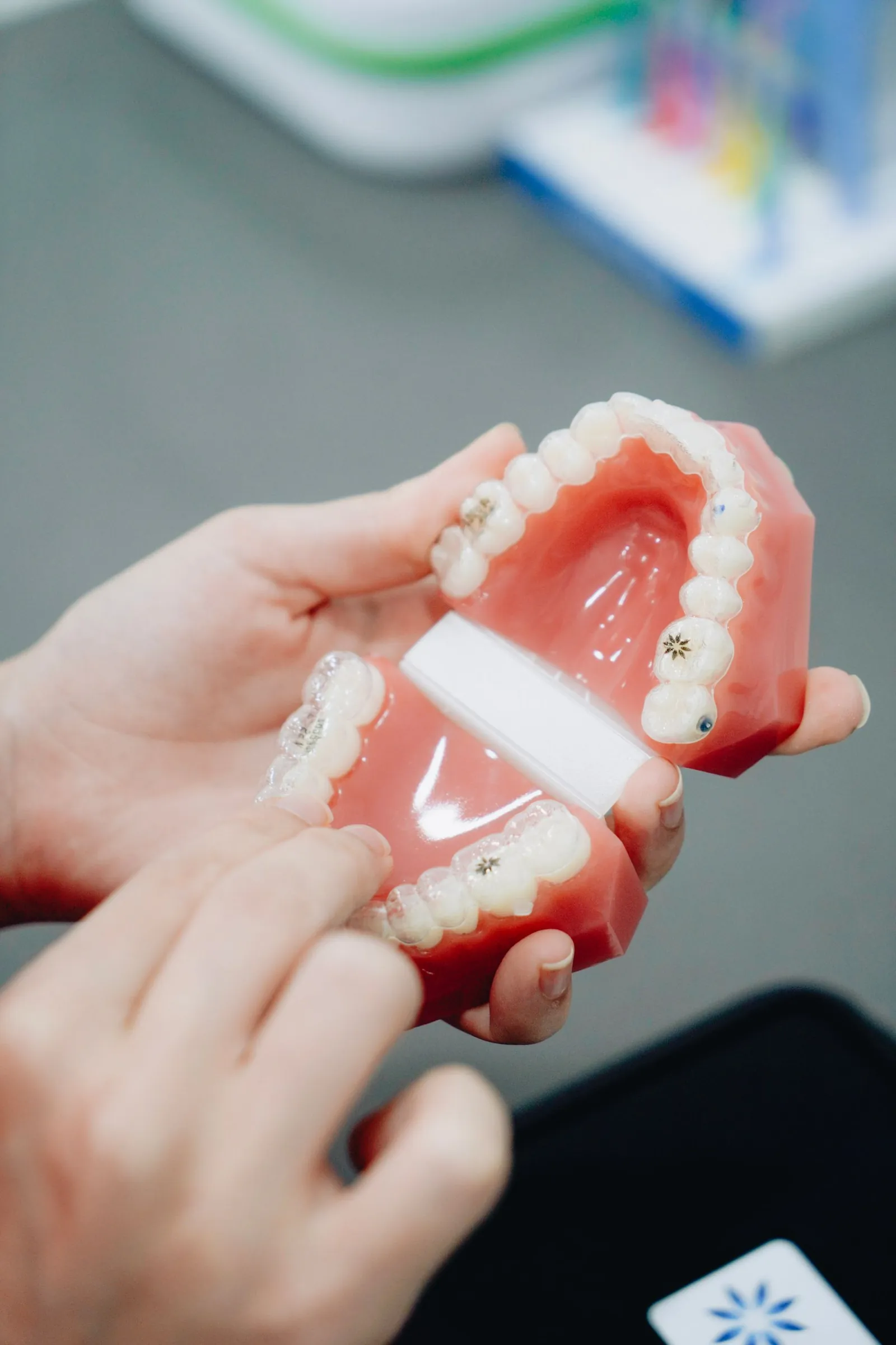 A dental study model held up, so the bite and the gumline can be seen.