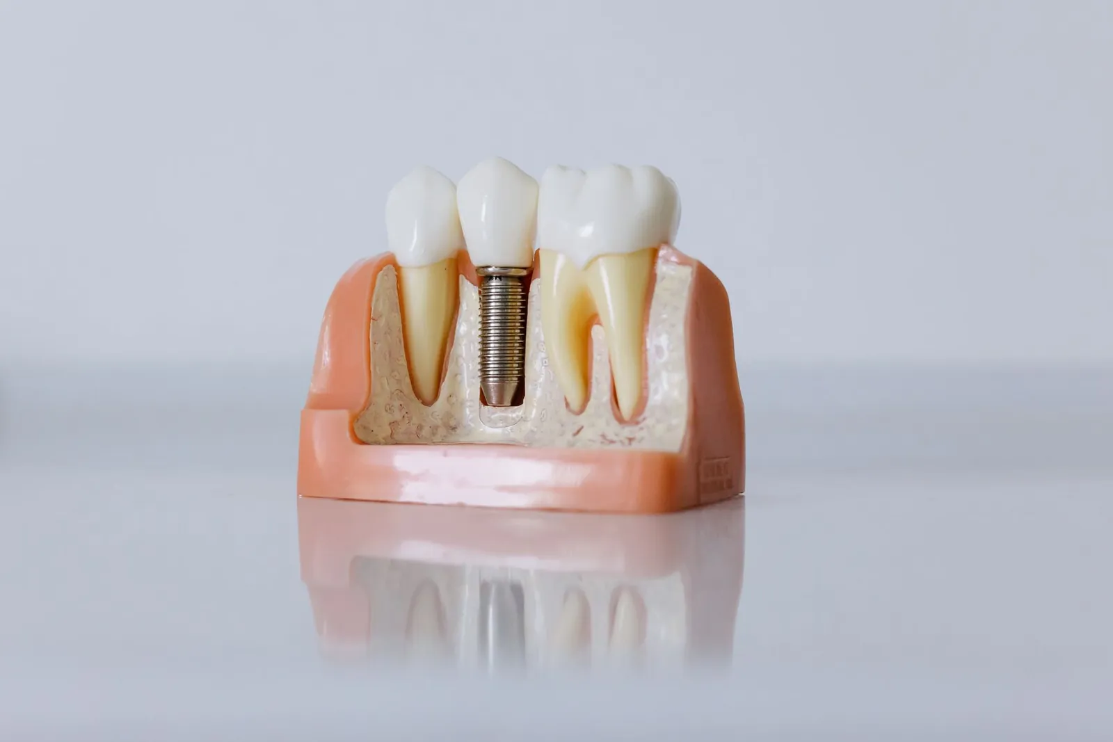 A sectioned model showing an implant seated in bone.